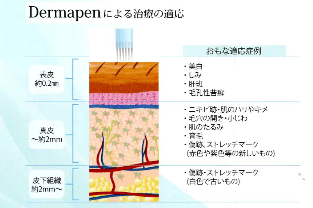Dermapenによる治療の適用